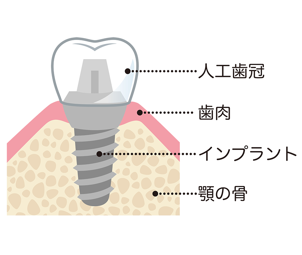 インプラントとは︖